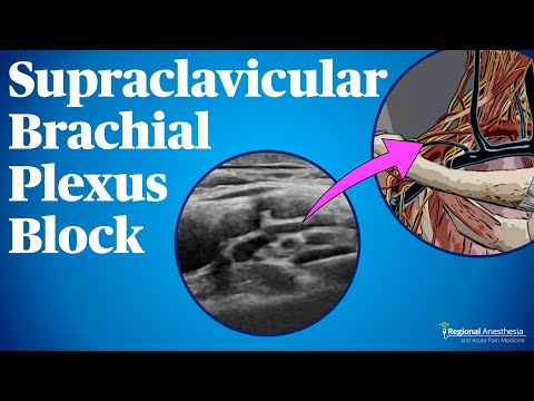 Видео: Блокада надключичного плечевого сплетения