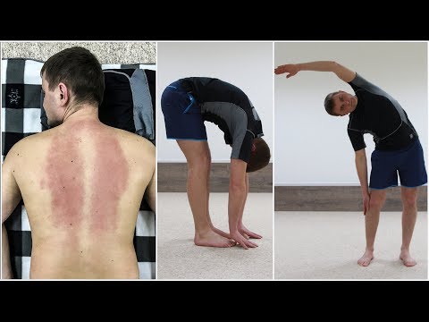 Видео: БОЛЕЗНЬ БЕХТЕРЕВА : ПРИГОВОР ИЛИ ЕСТЬ ЛЕЧЕНИЕ?
