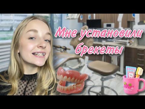 Видео: МНЕ УСТАНОВИЛИ БРЕКЕТЫ | МОЙ ПУТЬ К БРЕКЕТАМ | полный обзор с ценами | 200 ТЫСЯЧ