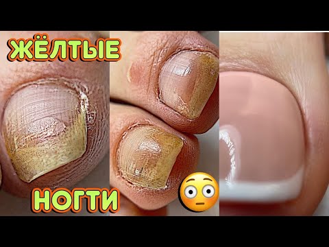 Видео: Желтые ногти 😟 Педикюр на клиенте / Как нарисовать Френч на ногах