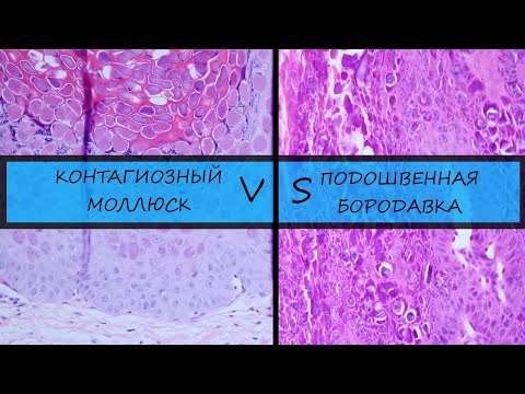 Видео: Контагиозный моллюск VS подошвенная бородавка (myrmecia wart)