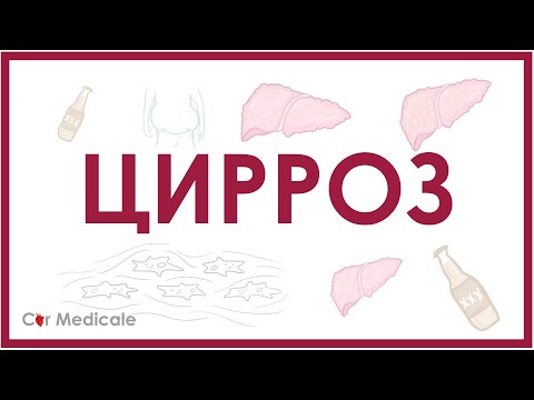 Видео: Цирроз печени - причины, патогенез, симптомы, осложнения