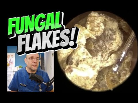 Видео: ГРИБКОВЫЕ ХЛОПЬЯ! 374 #ухо #ушнаясера #удалениеушнойсеры #ушнаясера #удовлетворение #длявас #fyp ...