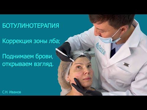Видео: Корректируем зону лба ботулотоксином, поднимаем брови наверх - открываем взгляд  👁👁