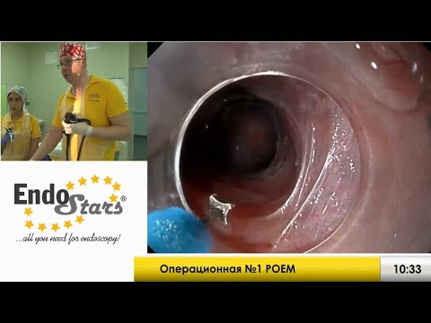 Видео: Ахалазия кардии, клинический случай №5, МКНЦ 23.01.19