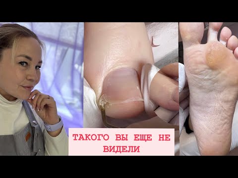 Видео: Педикюр без покрытия /мозоли / вросший ноготь /В ПЕРВЫЕ НА ПЕДИКЮРЕ 