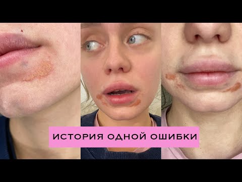 Видео: УВЕЛИЧЕНИЕ ГУБ. МОЙ УЖАСНЫЙ ОПЫТ. ВСЯ ПРАВДА