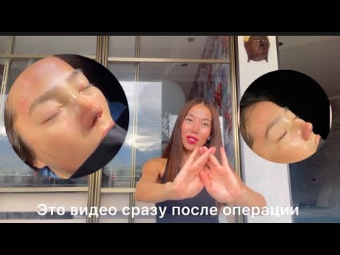 Видео: VLOG: Как я решилась на ринопластику / до и после ринопластики #surgeon