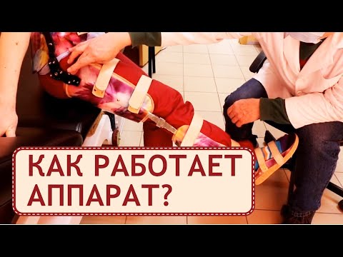 Видео: 🚶  Обзор ортопедического аппарата на всю ногу с корсетом. Аппарат на всю ногу. Персей Орто. 12+