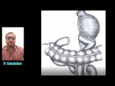 Видео: Желудочно-тощекишечный анастомоз по РУ (Гастроеюностомия)