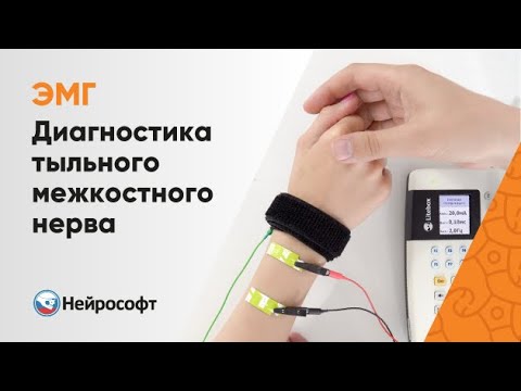 Видео: ЭМГ: Диагностика Тыльного Межкостного Нерва (Лучевой Нерв)