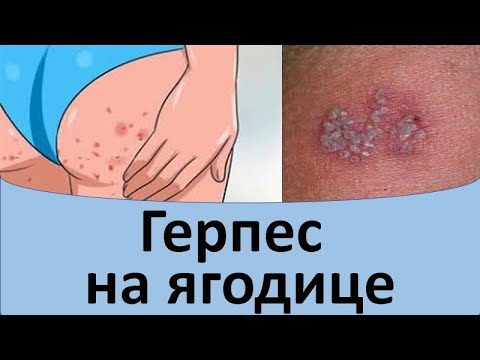 Видео: Герпес на ягодице