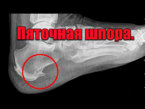 Видео: Главная ошибка в лечении пяточной шпоры, которую делают 90% людей.