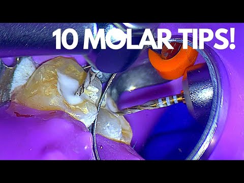 Видео: Топ-10: советы по лечению корневых каналов моляров, которые облегчат жизнь