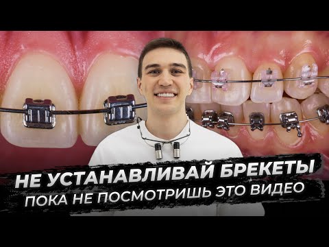 Видео: Не устанавливайте брекеты, пока не посмотрите это видео