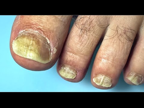 Видео: И такое бывает 😯 /Сложный случай… Педикюр