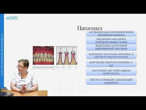 Видео: Пародонтит