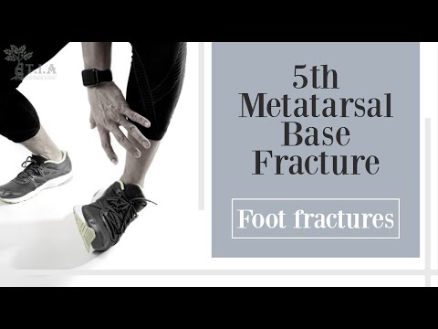 Видео: Перелом основания 5-й плюсневой кости - перелом стопы (субтитры)