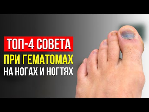 Видео: ТОП-4 СОВЕТА ПРИ ГЕМАТОМАХ НА НОГАХ И ПОД НОГТЯМИ! КАК ИЗБАВИТЬСЯ ОТ СИНЯКОВ? СОВЕТЫ ПОДОЛОГОВ