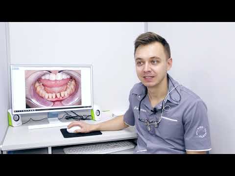 Видео: Шинирование при пародонтозе. Телемедицина