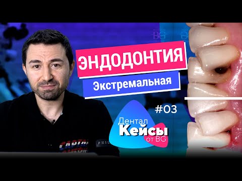 Видео: Экстремальная эндодонтия и сложная реставрация. Дентал Кейсы от BG. #03