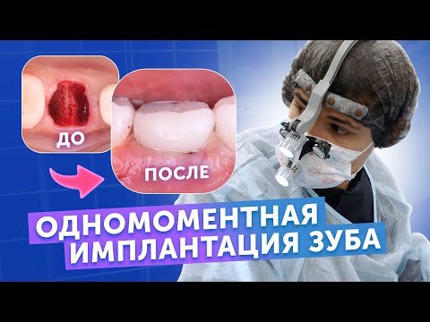 Видео: Удаление зуба и установка импланта за один прием