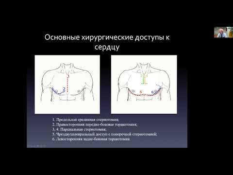 Видео: Доступы к сердцу. Кардиохирургия для кардиологов. БМ-2. Профессор Шихвердиев Н.Н.