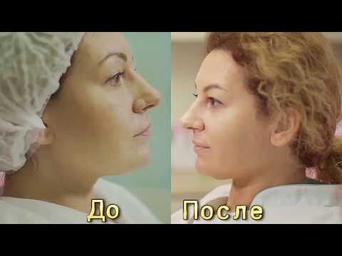 Видео: отзыв Наноазия До и После Nanoasia. Мезотерапия без инъекций