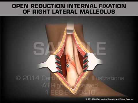 Видео: Открытая репозиция и накостный остеосинтез правой наружной лодыжки пластиной с угловой стабильностью