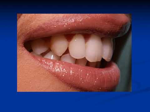 Видео: Лекция по осветлению зубов. Эстетическая стоматология. Кафедра клинической стоматологии. 4 курс