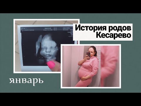 Видео: История моих родов // Кесарево сечение