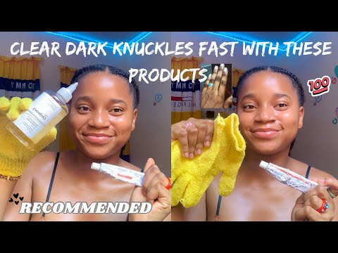 Видео: КАК БЫСТРО ИЗБАВИТЬСЯ ОТ ТЕМНЫХ ПЯТЕН НА КОСТЯХ ПАЛЬЦЕВ С ПОМОЩЬЮ ПРОСТЫХ ШАГОВ | Получите более ...