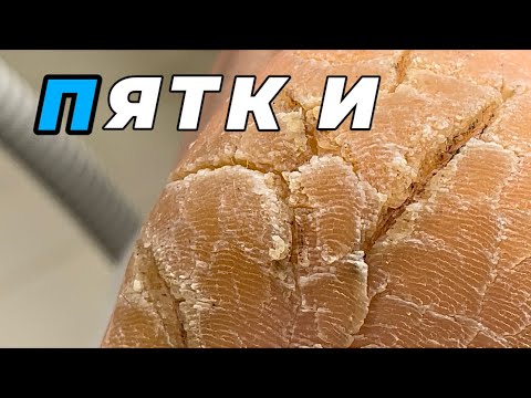 Видео: Пятки до состояния потрескавшейся земли. Колонии грибов в условиях влажной среды #подологтатьянапак