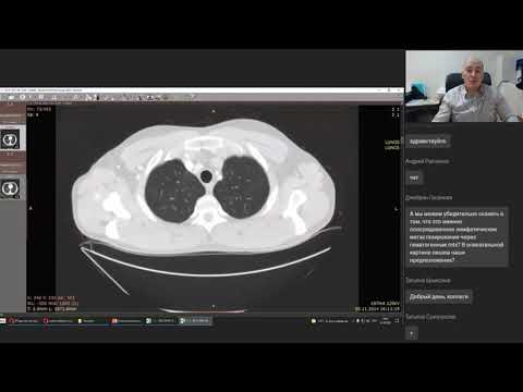 Видео: КТ диагностика метастатического поражения лёгких