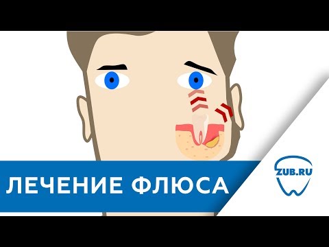 Видео: Флюс // Лечение флюса
