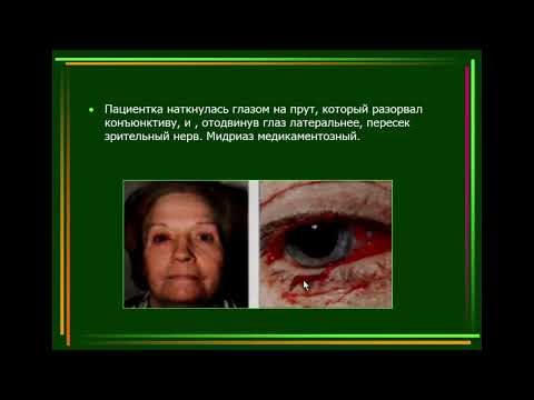 Видео: 9:40 Травмы и ожоги органа зрения. Оказание неотложной помощи в офтальмологии.