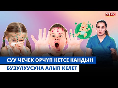 Видео: Суу чечек менен ооруган балага зелёнка жардам береби? | "БӨБӨК" КӨРСӨТҮҮСҮ