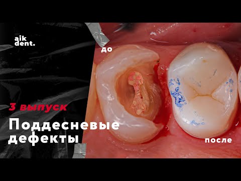 Видео: Поддесневые дефекты. Выпуск 3. aikdent.school