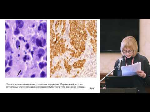 Видео: Морфологические особенности и белок bcl2 при раке молочной железы с мутацией 538insC гена BRCA1