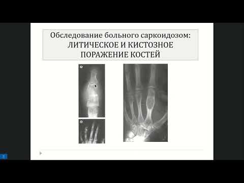 Видео: Визель А.А. Саркоидоз что делать И чего не делать