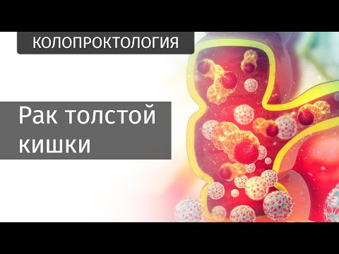 Видео: Рак толстой кишки | Частная патология