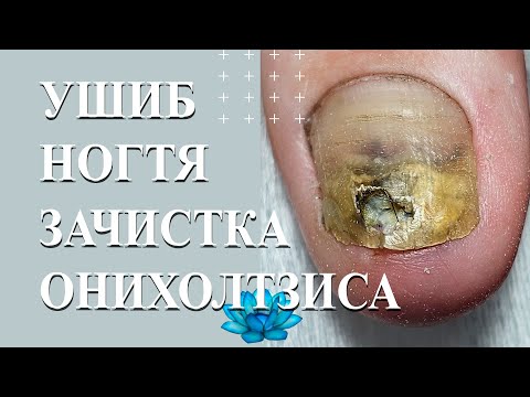 Видео: Аппаратный педикюр, когда у клиента ушиб пальца на ноге.