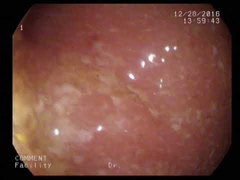 Видео: Эрозивный проктит, биопсия слизистой прямой кишки