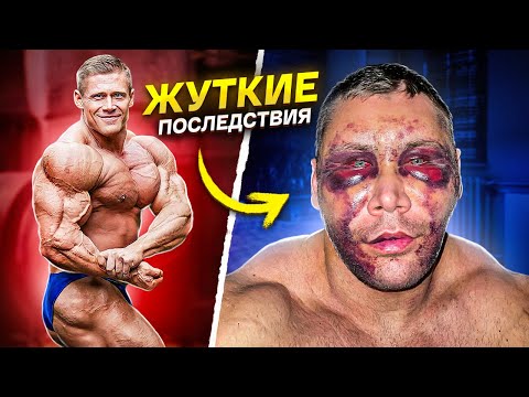 Видео: КАЧОК ИСПОРТИЛ СЕБЕ ЛИЦО / последствия фейслифтинга