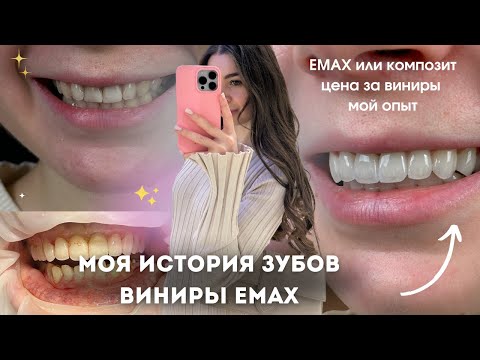 Видео: МОЯ ИСТОРИЯ ЗУБОВ | виниры emax, коронки, пломбы и сколько это стоит