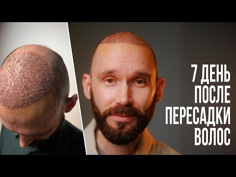 Видео: 7 день после пересадки волос