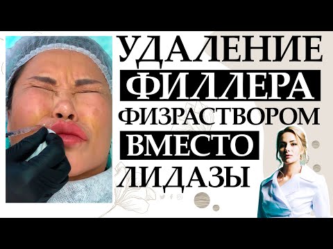 Видео: Удаление филлера физраствором вместо лидазы