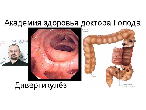 Видео: Дивертикулы толстой кишки и девиртикулёз. Что это такое и как это лечить?