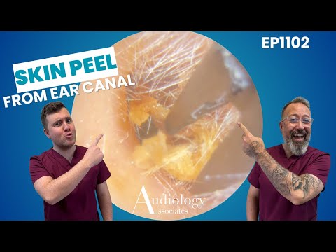 Видео: ОБШИРНОЕ ОТСЛОЕНИЕ КОЖИ СО СТЕНКИ УШНОГО ПРОХОДА - EP1102