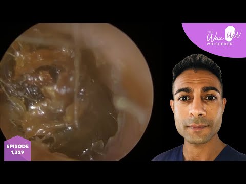 Видео: 1330 — Международная услуга по удалению ушной серы из Канады 🇨🇦